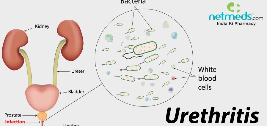 Non-gonococcal urogenital inflammation