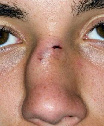 Nose injuries and fractures