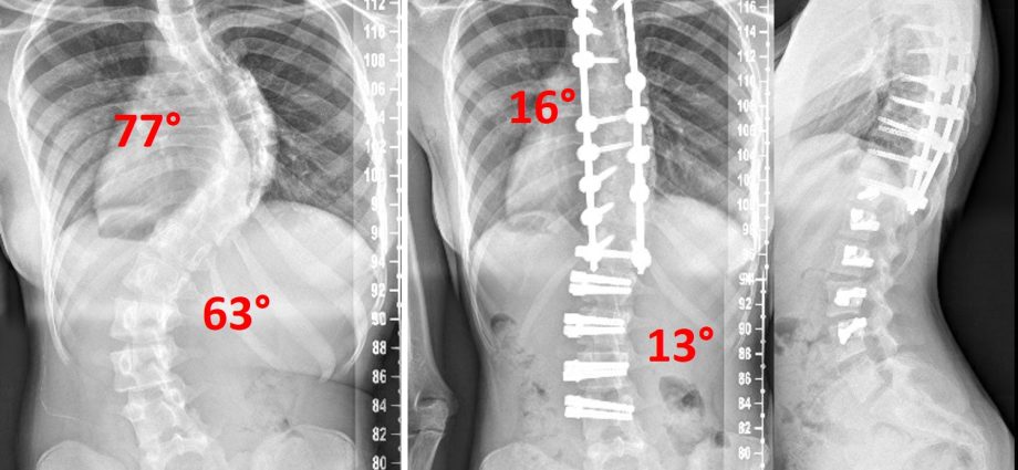 Not only surgery &#8211; scoliosis can be treated differently