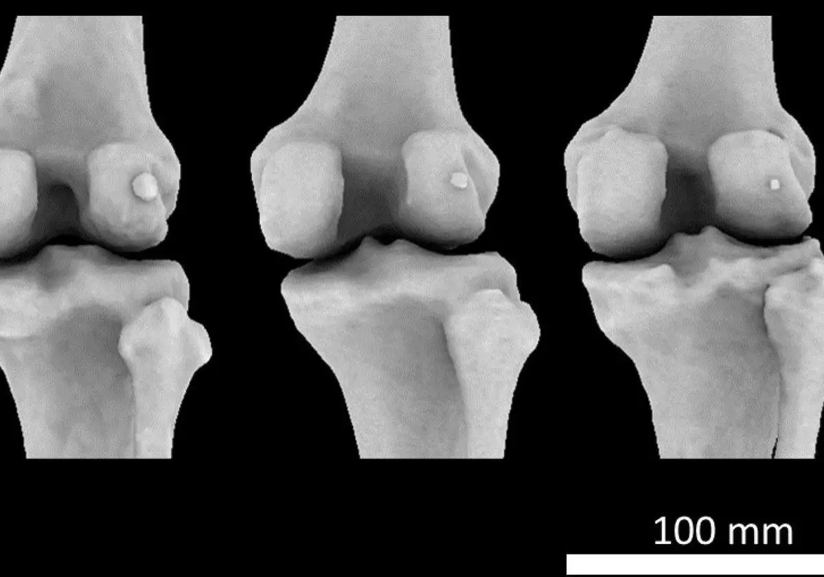 Novel treatment of patellar cancer. This operation is one of the first in the world