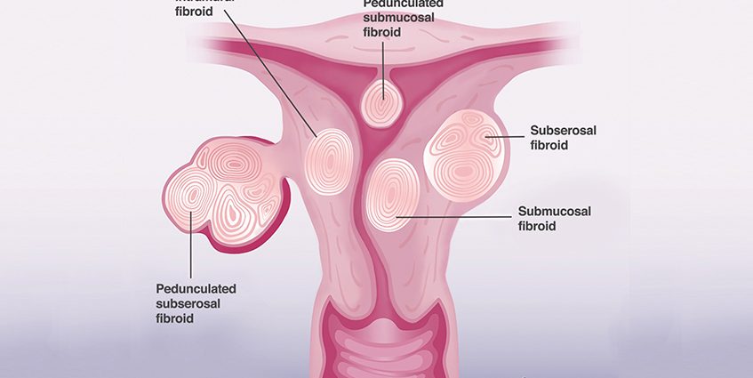 Now it&#8217;s easier to get rid of fibroids