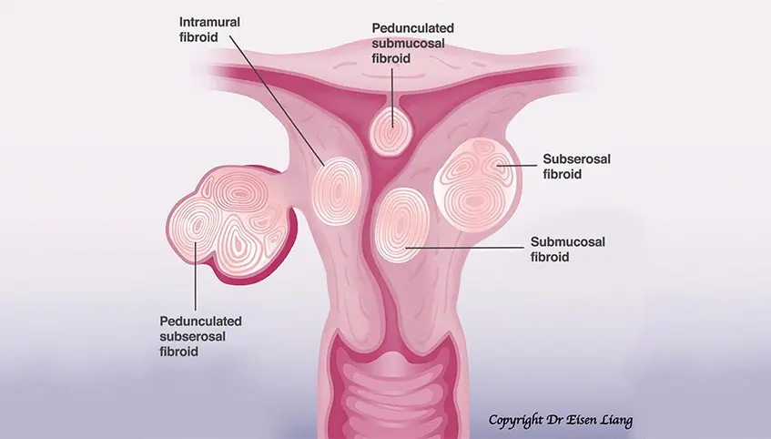 Now it&#8217;s easier to get rid of fibroids