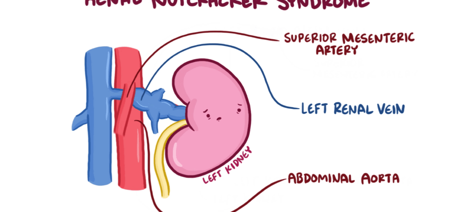 Nutcracker syndrome &#8211; types, causes, symptoms. What is the diagnosis and treatment?