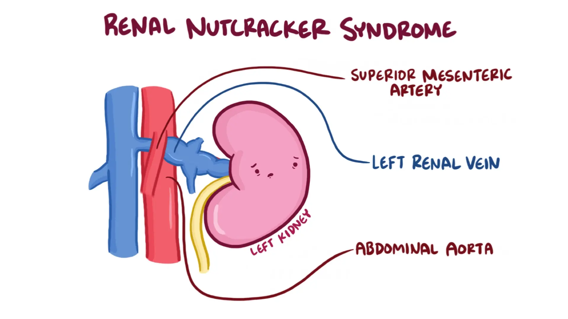 Nutcracker Syndrome Types Causes Symptoms What Is The Diagnosis