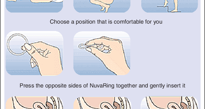 NuvaRing &#8211; a new method of contraception