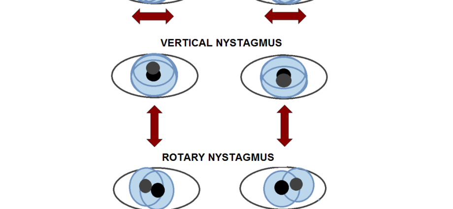 Nystagmus