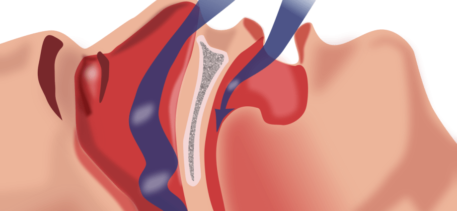 Obstructive Sleep Apnea (OBPS)