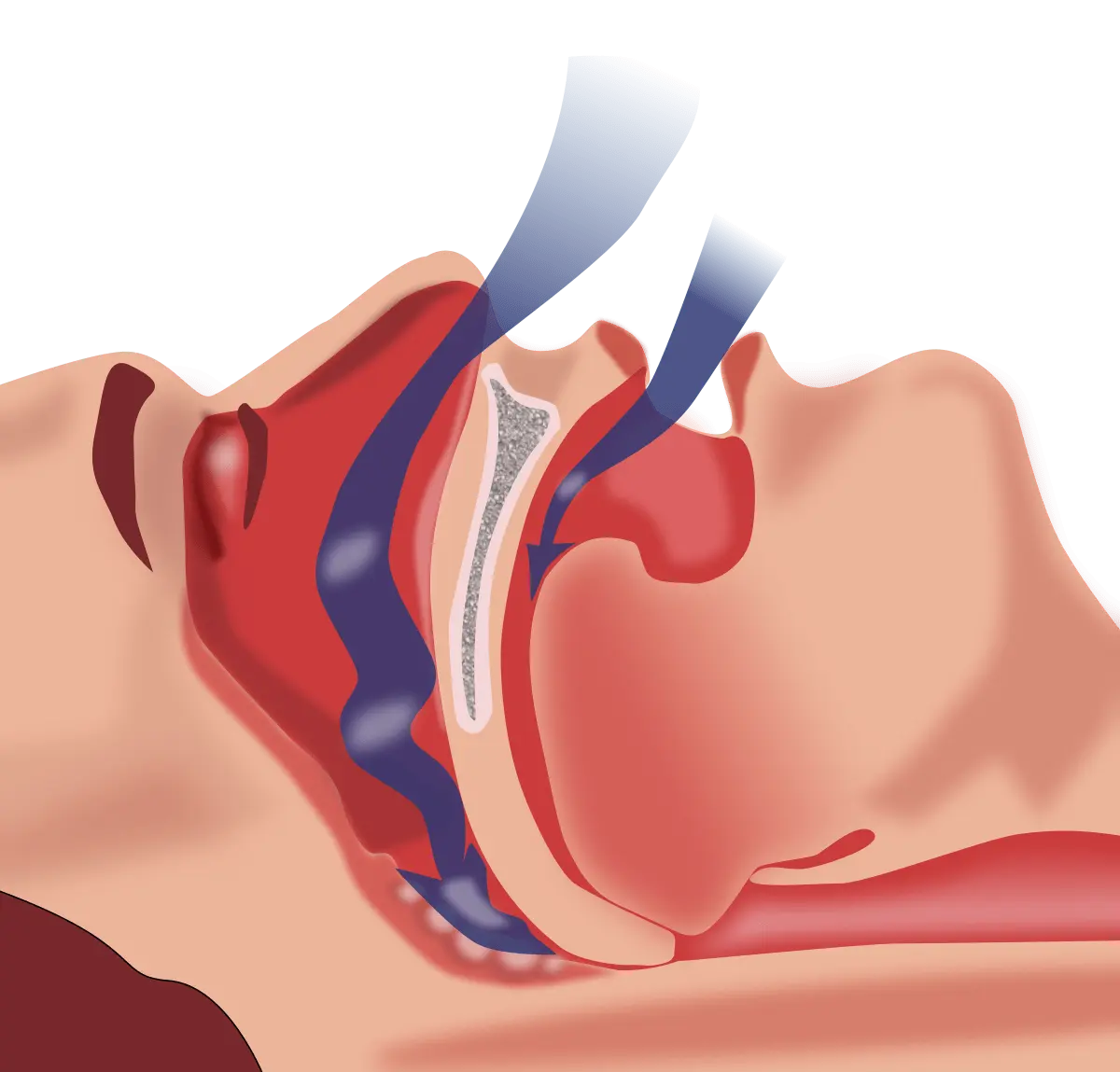 Obstructive Sleep Apnea (OBPS)