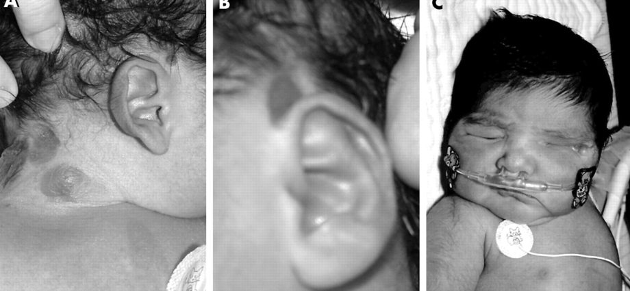 Oculocerebral cutaneous syndrome