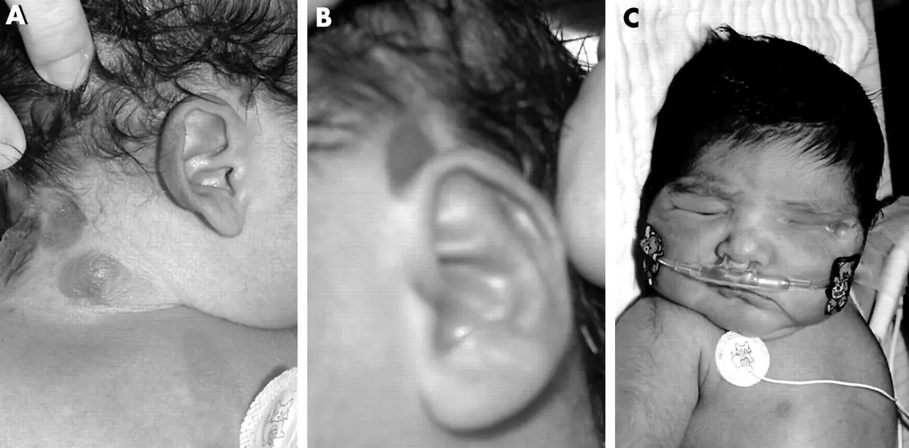 Oculocerebral cutaneous syndrome