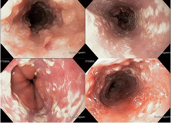 Oesophageal mycosis &#8211; symptoms, diagnosis, treatment. What could be the reasons?