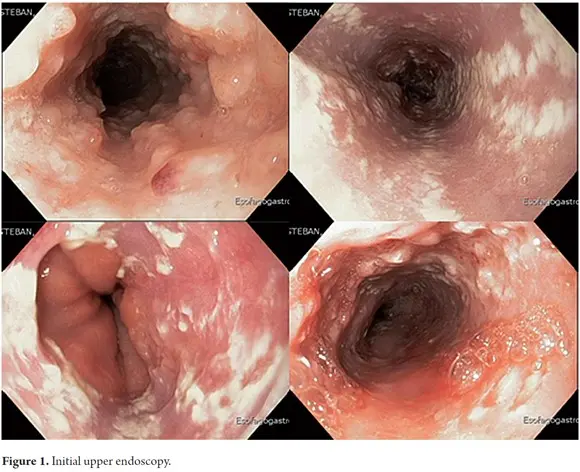 Oesophageal mycosis &#8211; symptoms, diagnosis, treatment. What could be the reasons?