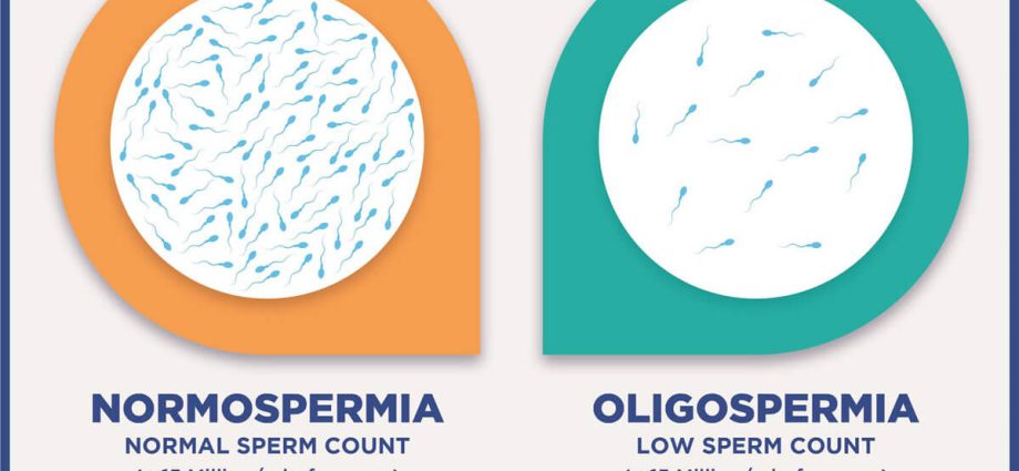 Oligospermia &#8211; definition, causes, diagnosis, treatment of reduced sperm count in semen