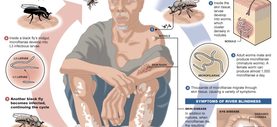 Onchocercosis &#8211; causes, symptoms, treatment