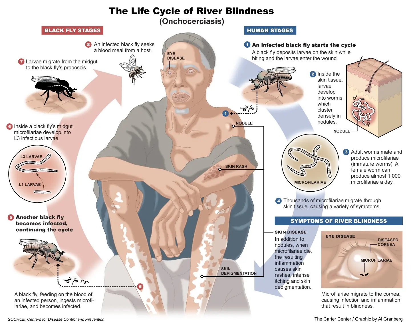 Onchocercosis &#8211; causes, symptoms, treatment