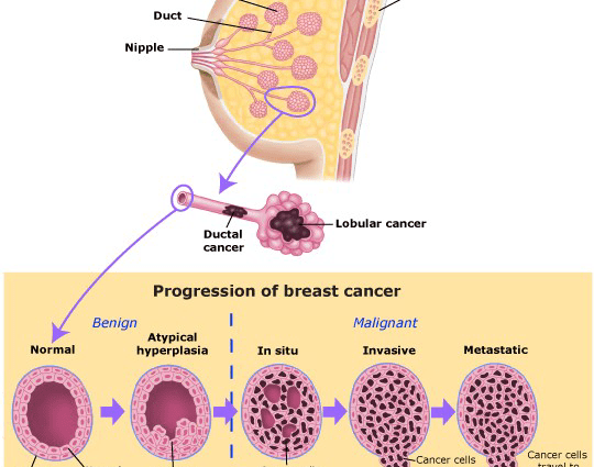 Oncologists with the most aggressive type of breast cancer