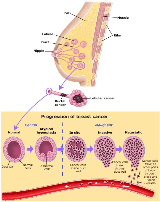 Oncologists with the most aggressive type of breast cancer