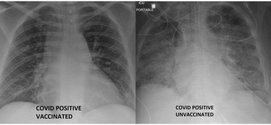 One got vaccinated, the other did not. Their lungs after COVID-19 look completely different