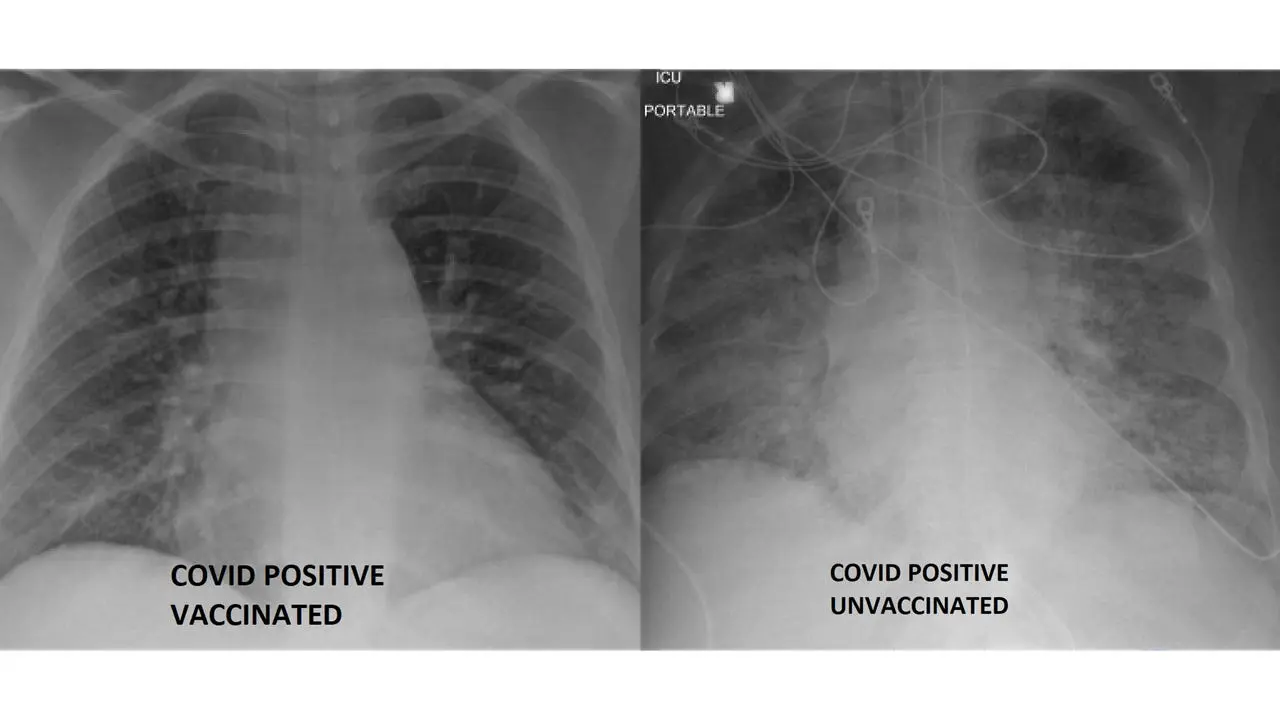 One got vaccinated, the other did not. Their lungs after COVID-19 look completely different