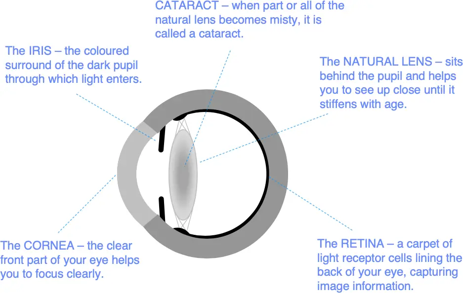 One operation, two benefits. What does a modern cataract removal procedure look like?