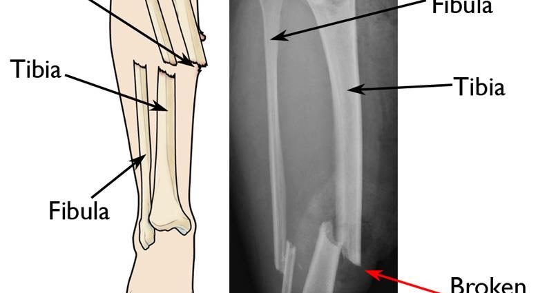 Open fracture. How to help so as not to harm? The orthopedist advises