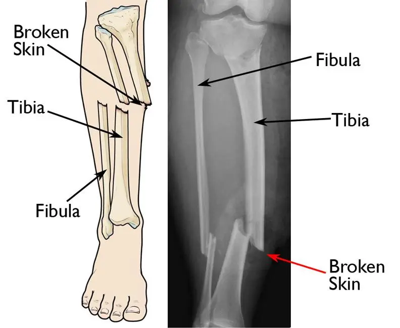 Open fracture. How to help so as not to harm? The orthopedist advises