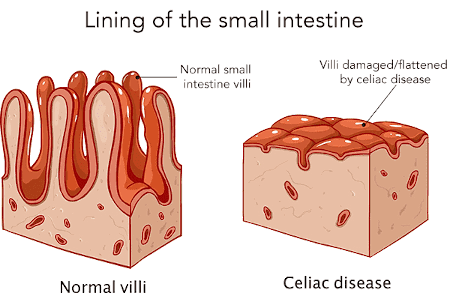 Or is it celiac disease?