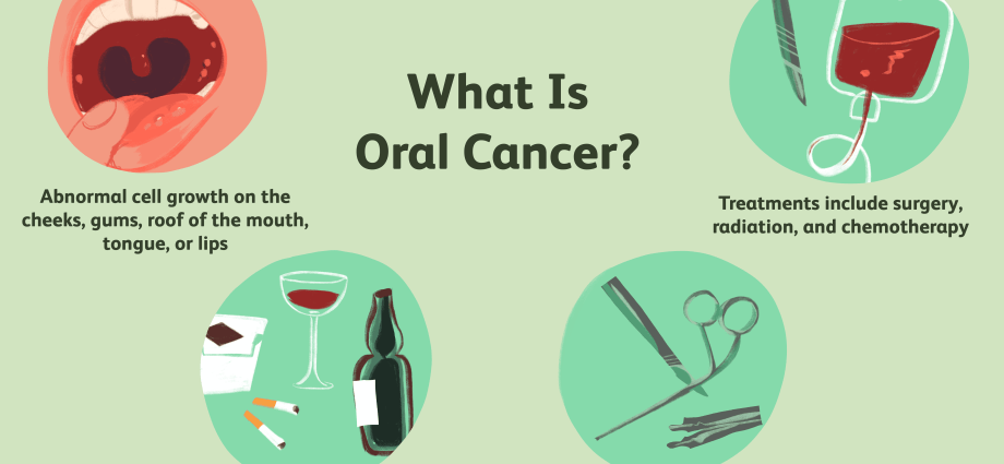 Oral cancer &#8211; causes, symptoms and treatment