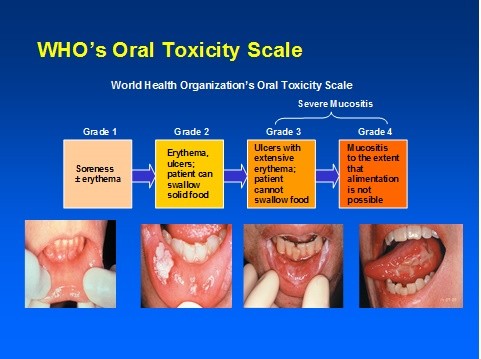 Oral mucositis - zizindikiro, chithandizo, kupewa