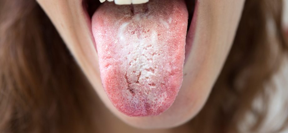 Oral mycosis &#8211; types, causes, symptoms, treatment