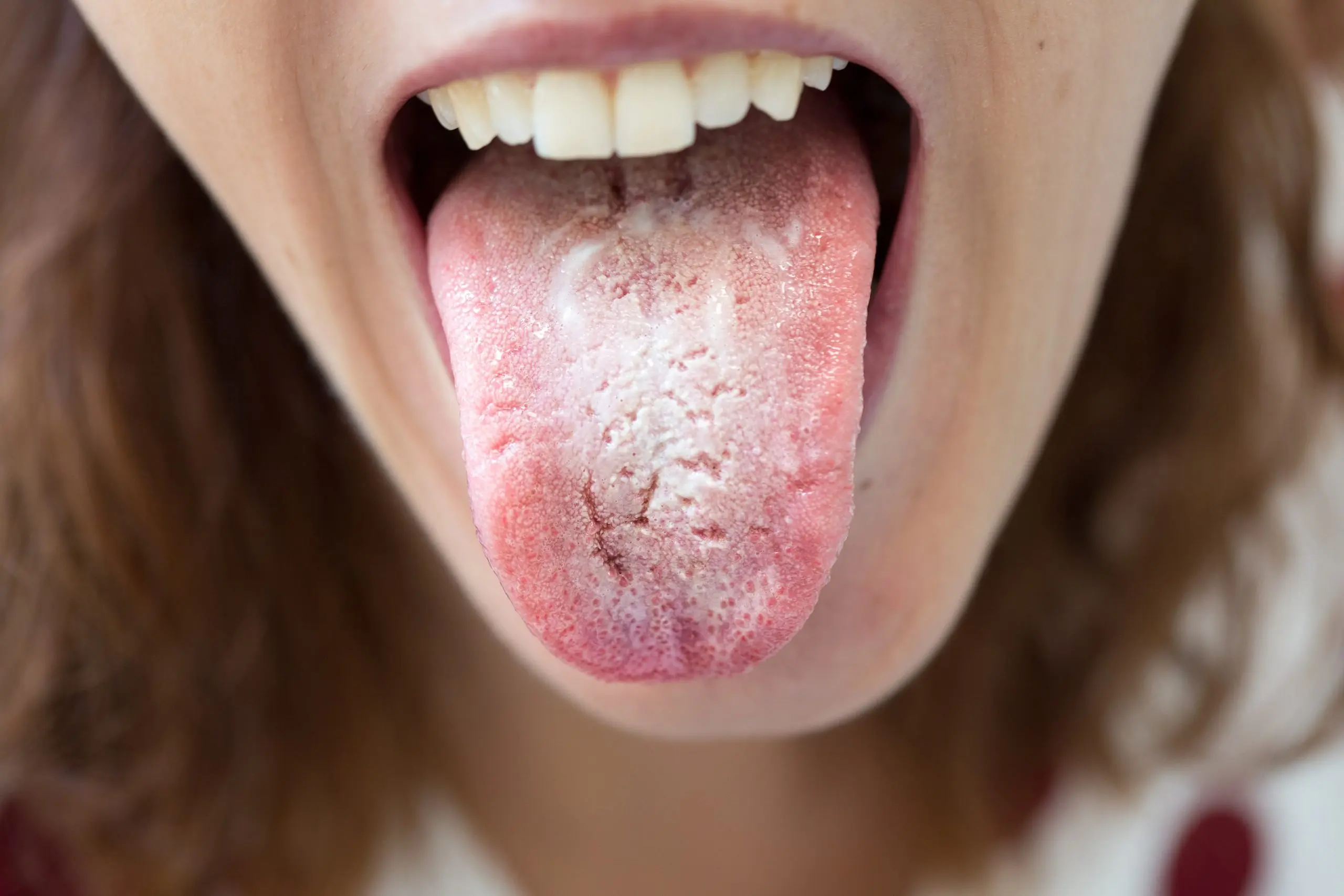 Oral mycosis &#8211; types, causes, symptoms, treatment