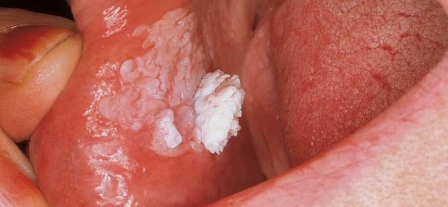 Oral papillomatosis