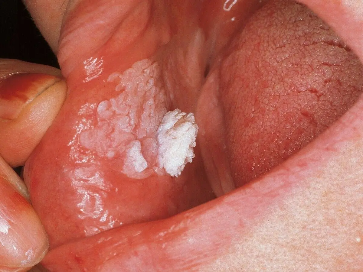 Oral papillomatosis