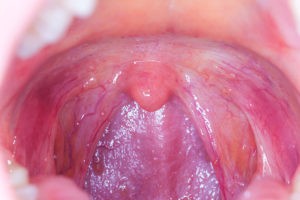 Oral sex can cause neck and head cancers