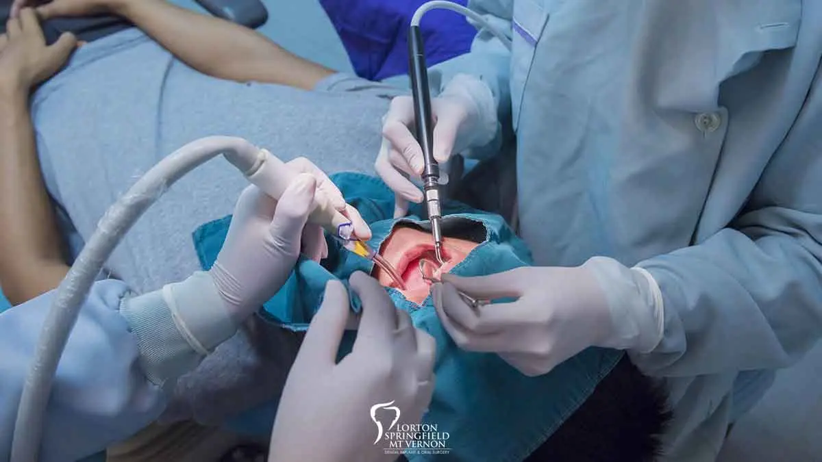 Oral surgery &#8211; what does it do? When to visit the oral surgeon?