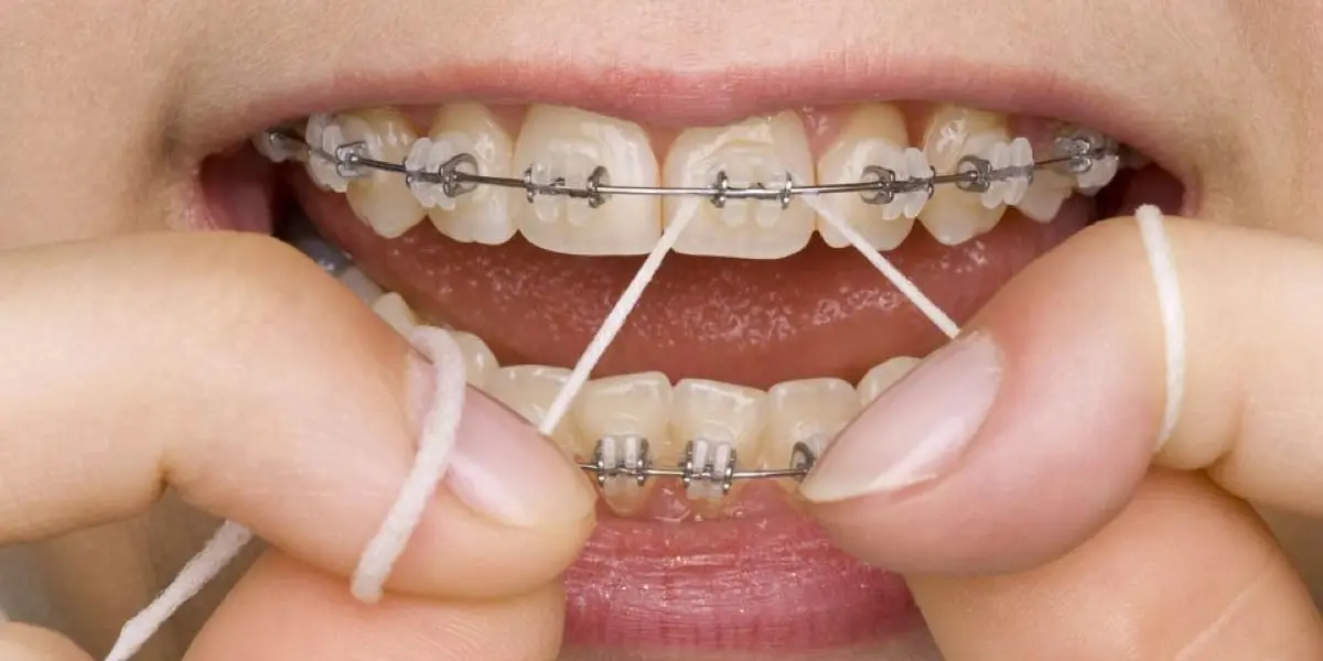 Orthodontic appliance and oral hygiene