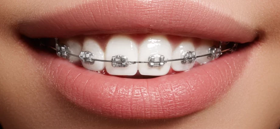 Orthodontic appliance cost &#8211; how much does a beautiful smile cost?