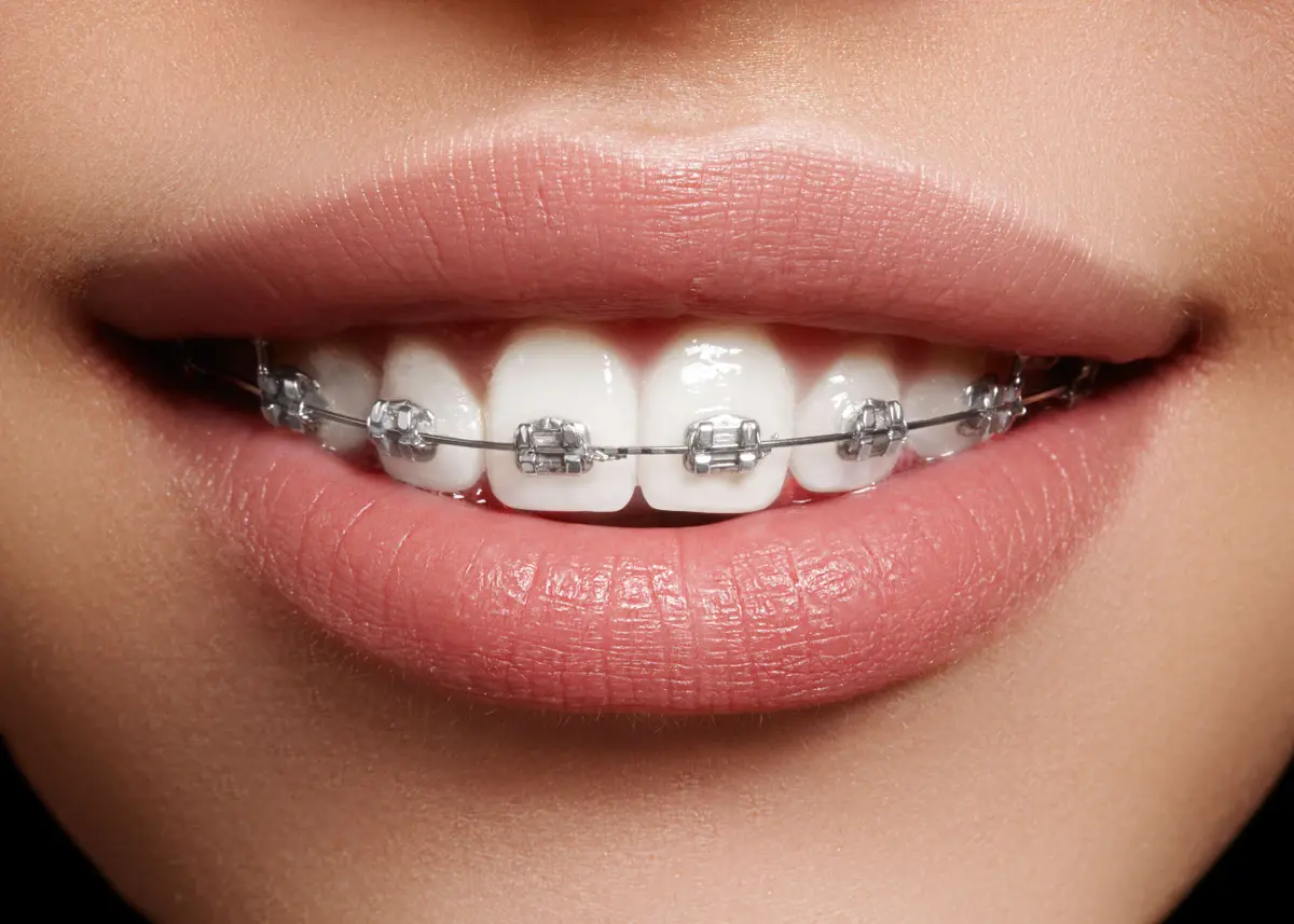 Orthodontic appliance cost &#8211; how much does a beautiful smile cost?