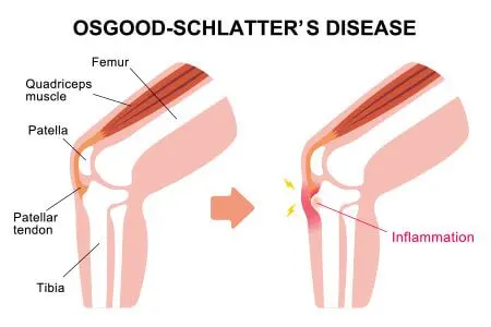 Osgood Schlatter&#8217;s disease &#8211; symptoms, diagnosis, treatment