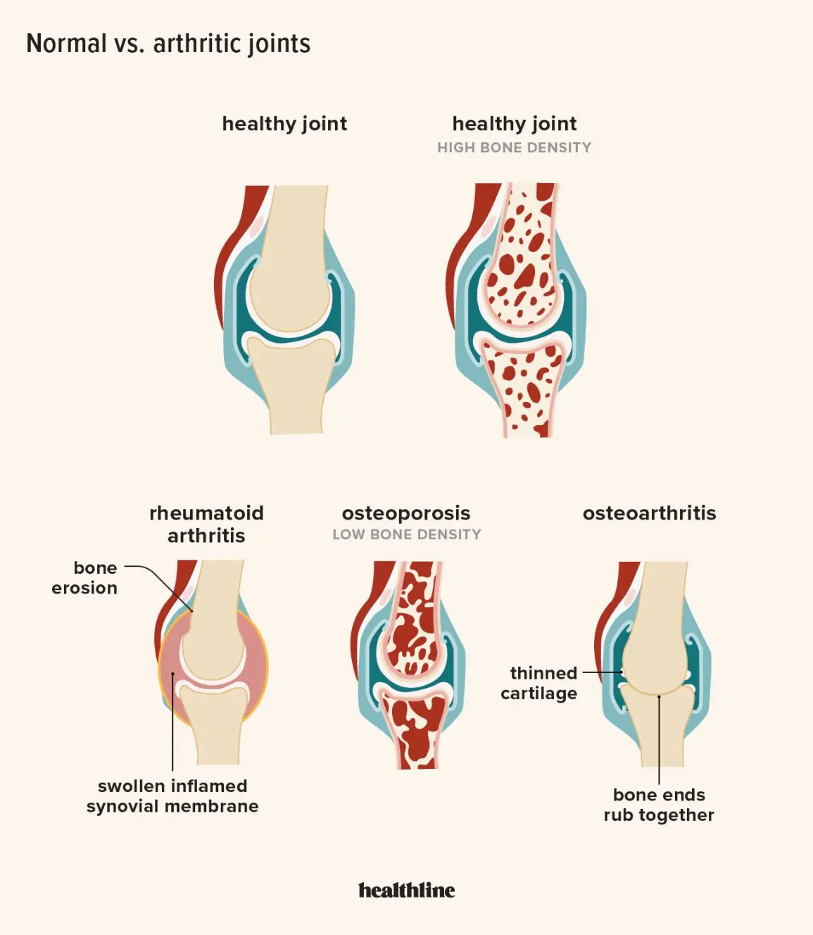 Osteoarthritis &#8211; causes and treatment