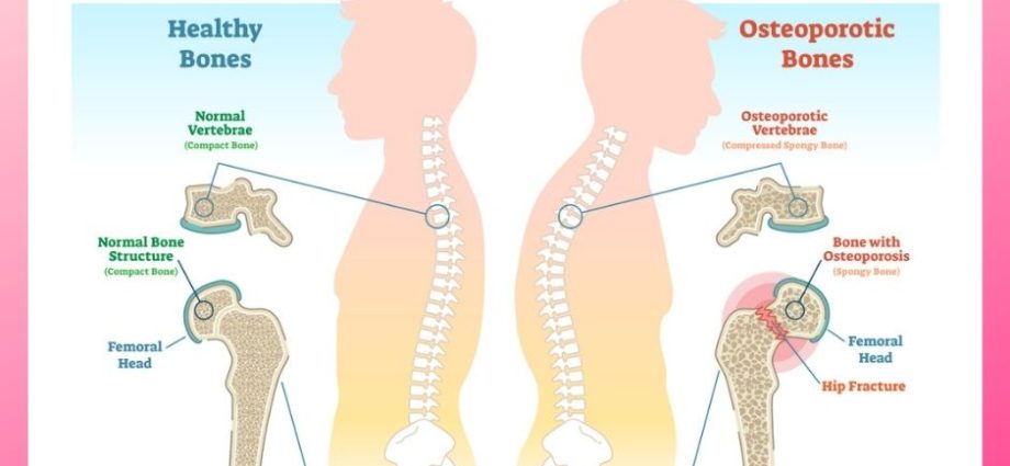 Osteopenia &#8211; characteristics and prevention