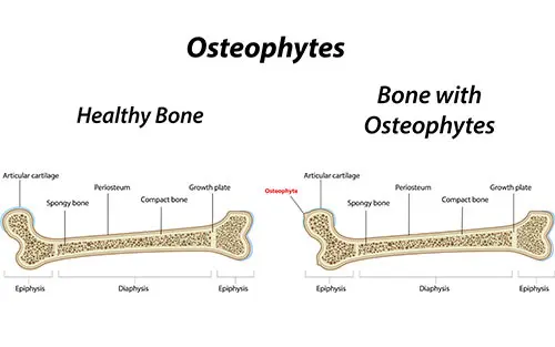 Osteophytes, or bone growths &#8211; causes, symptoms, treatment