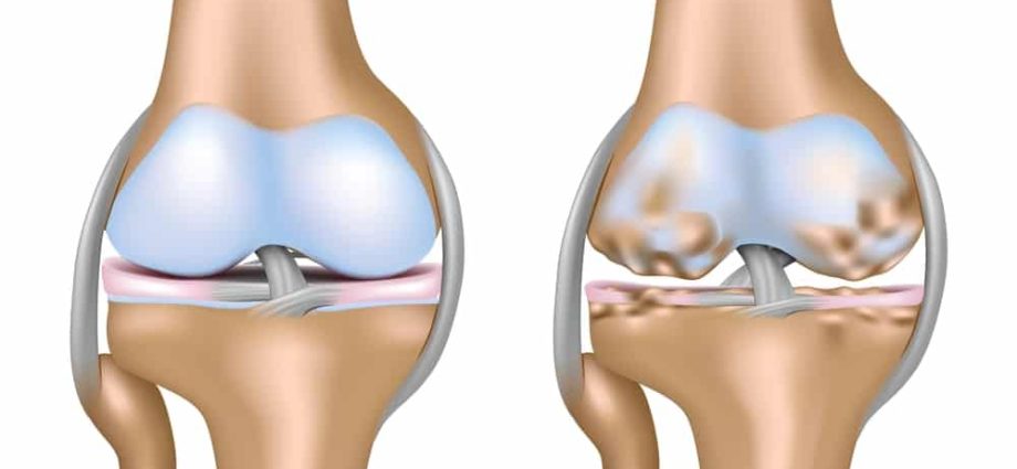 Osteophytosis &#8211; course, causes, symptoms. How to treat bone degenerative changes?