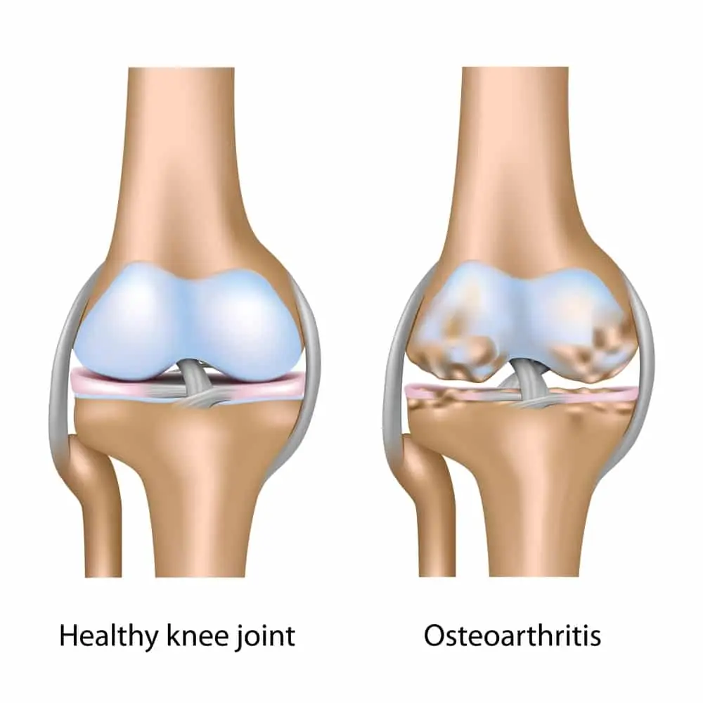 Osteophytosis &#8211; course, causes, symptoms. How to treat bone degenerative changes?