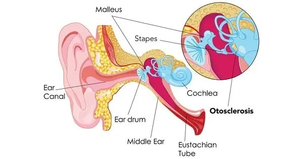 Otosclerosis (otospongiosa)