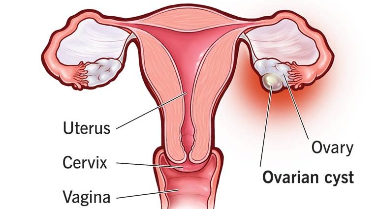 Ovarian cysts &#8211; symptoms and types of cysts on the ovary