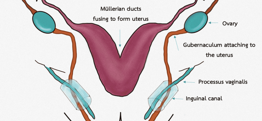 Ovarian hydrocele