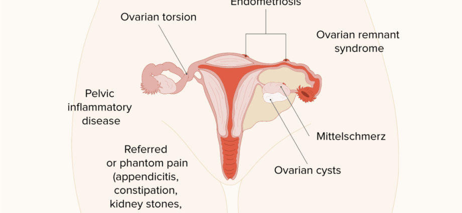 Ovarian inflammation &#8211; causes, symptoms and treatment