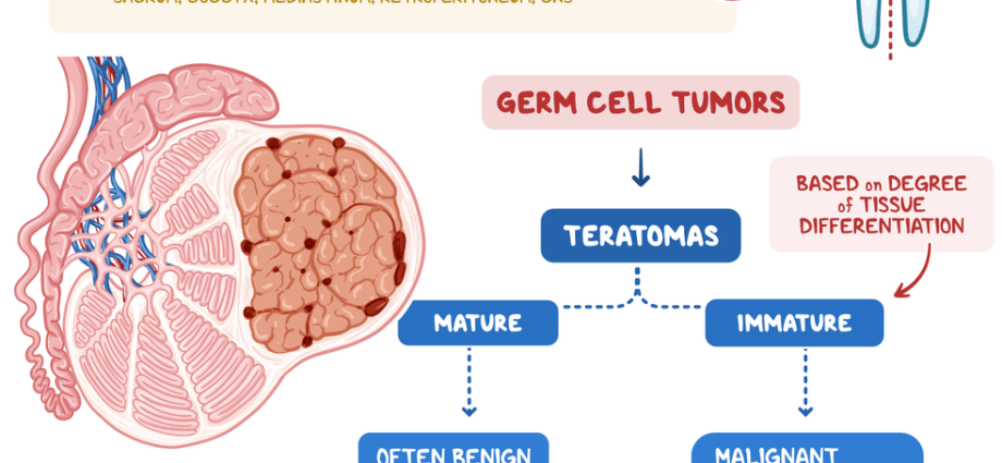 Ovarian teratomas &#8211; symptoms and prognosis. Treatment of ovarian teratomas