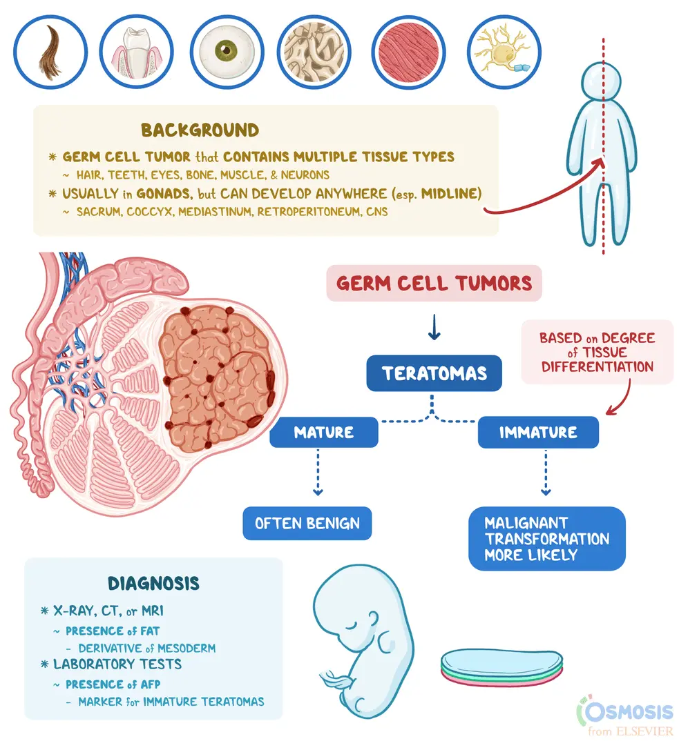 Ovarian teratomas &#8211; symptoms and prognosis. Treatment of ovarian teratomas